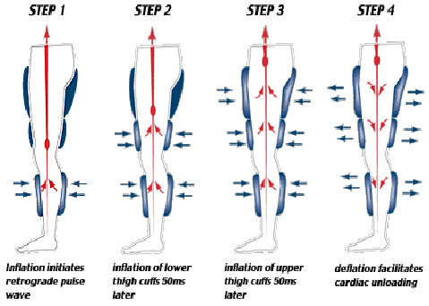Image showing steps in EECP treatment