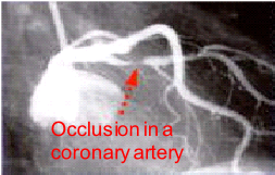 Occlusion in a coronary artery